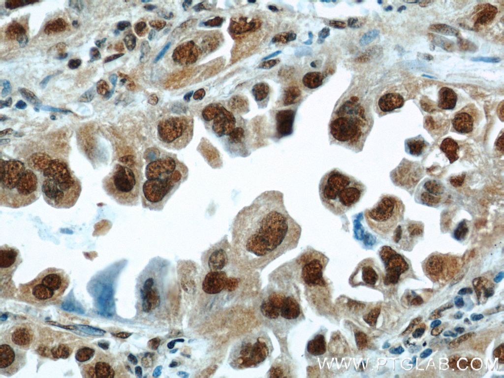 IHC staining of human lung cancer using 11344-1-AP