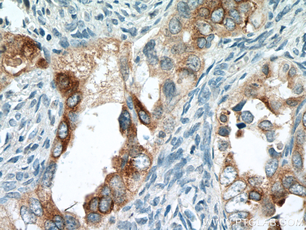 IHC staining of human ovary tumor using 66557-1-Ig