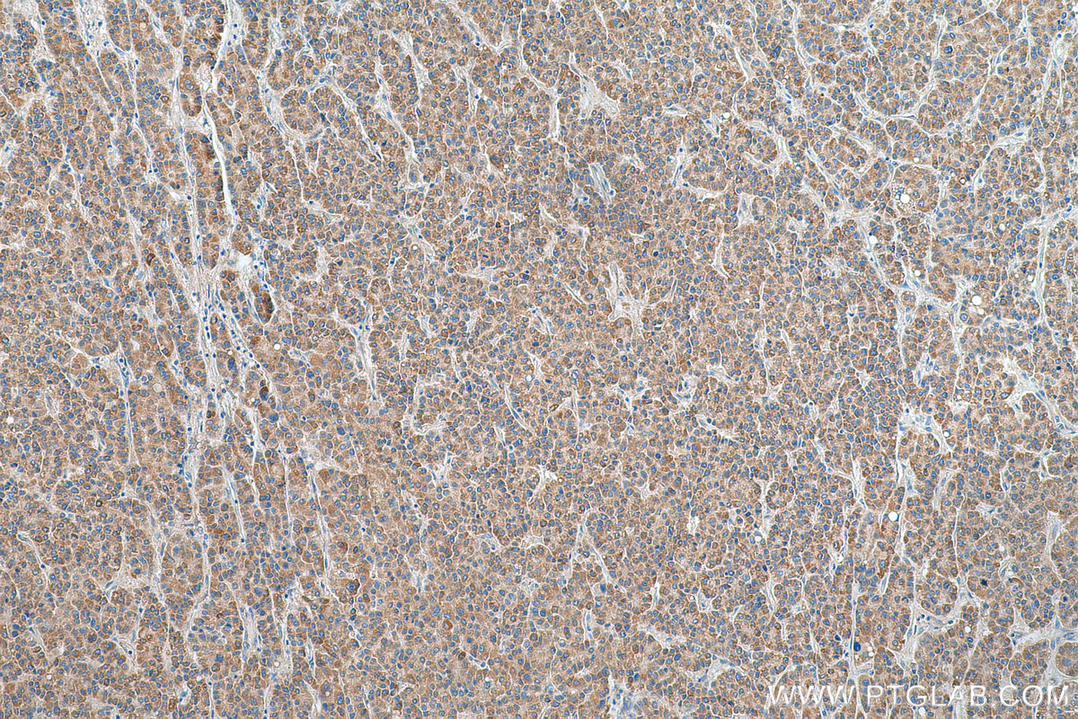 IHC staining of human liver cancer using 16842-1-AP