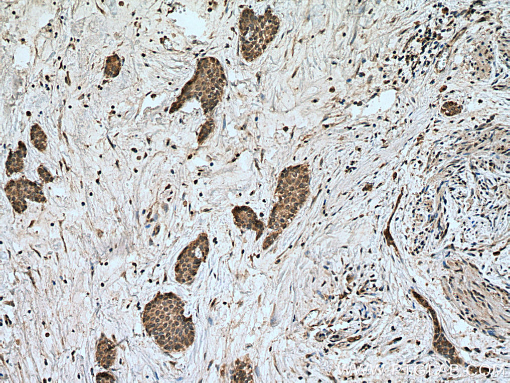 IHC staining of human urothelial carcinoma using 24695-1-AP