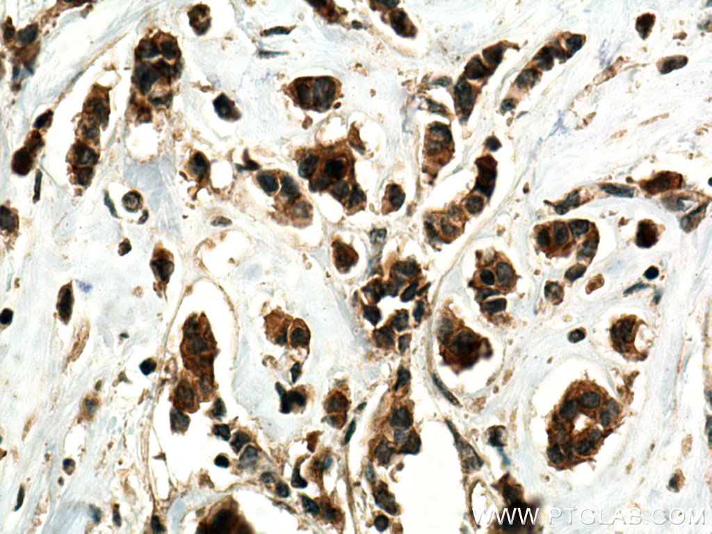 IHC staining of human breast cancer using 26635-1-AP