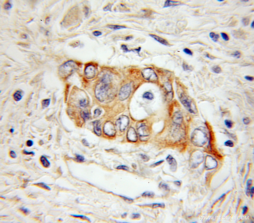 IHC staining of human pancreas cancer using 11148-1-AP