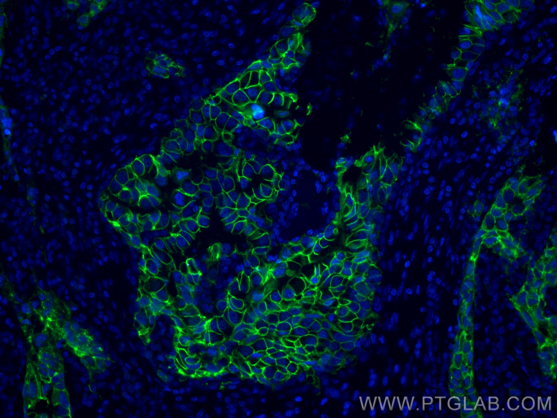 IF Staining of human breast cancer using CL488-60311