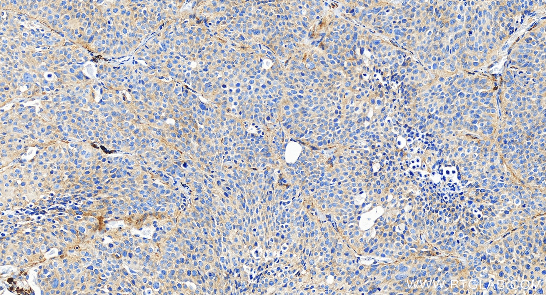IHC staining of human lung cancer using 85627-1-RR (same clone as 85627-1-PBS)