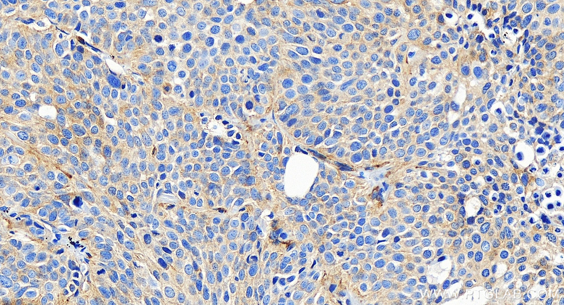 IHC staining of human lung cancer using 85627-1-RR (same clone as 85627-1-PBS)