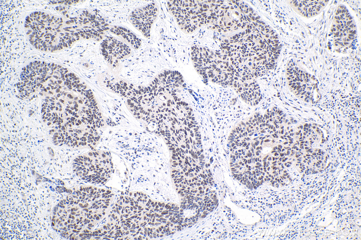 IHC staining of human lung cancer using 16598-1-AP