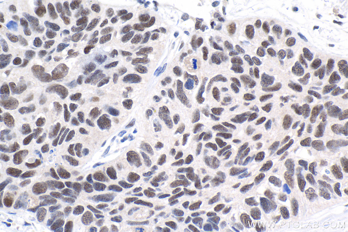 IHC staining of human lung cancer using 16598-1-AP