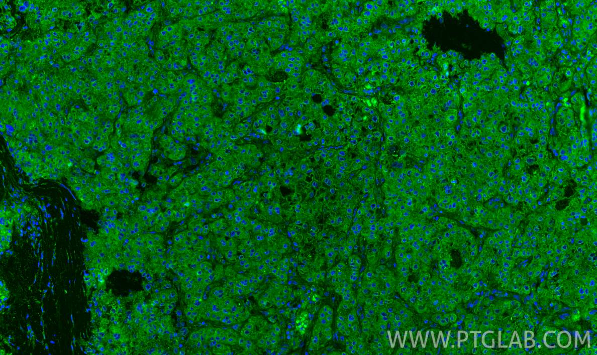 Immunofluorescent analysis of (4% PFA) fixed paraffin-embedded human liver cancer tissue using HGF antibody (26881-1-AP) at dilution of 1:200 and CoraLite®488-Conjugated Goat Anti-Rabbit IgG(H+L) (<a class='green' href='/productredirect?CatalogNo=SA00013-2' target='_blank'>SA00013-2</a>). Heat mediated antigen retrieval with Tris-EDTA buffer (pH 9.0). IF Staining of human liver cancer using 26881-1-AP