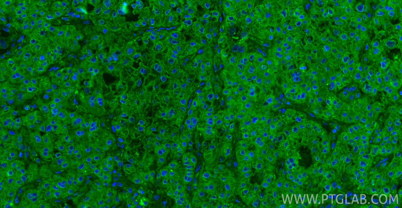 Immunofluorescent analysis of (4% PFA) fixed paraffin-embedded human liver cancer tissue using HGF antibody (26881-1-AP) at dilution of 1:200 and CoraLite®488-Conjugated Goat Anti-Rabbit IgG(H+L) (<a class='green' href='/productredirect?CatalogNo=SA00013-2' target='_blank'>SA00013-2</a>). Heat mediated antigen retrieval with Tris-EDTA buffer (pH 9.0). IF Staining of human liver cancer using 26881-1-AP