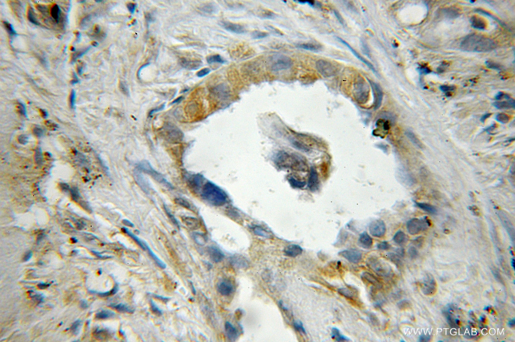 IHC staining of human lung cancer using 12399-1-AP (same clone as 12399-1-PBS)