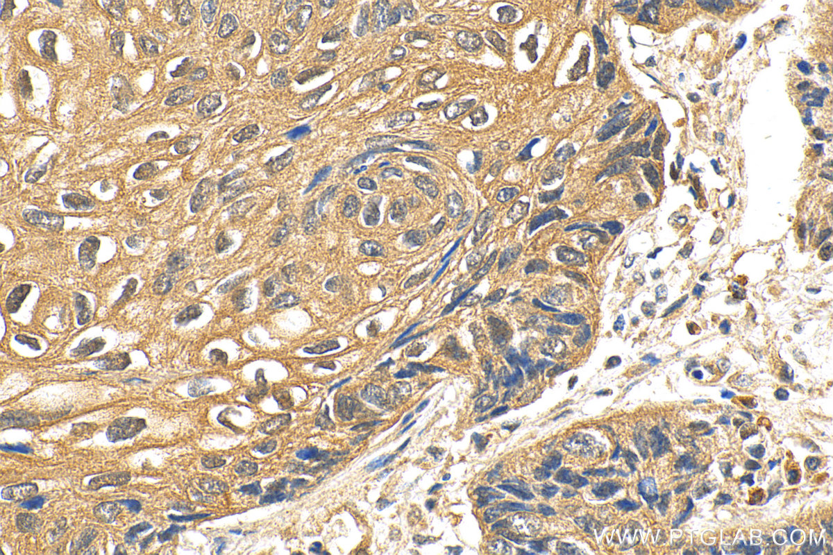 IHC staining of human lung cancer using 10646-1-AP