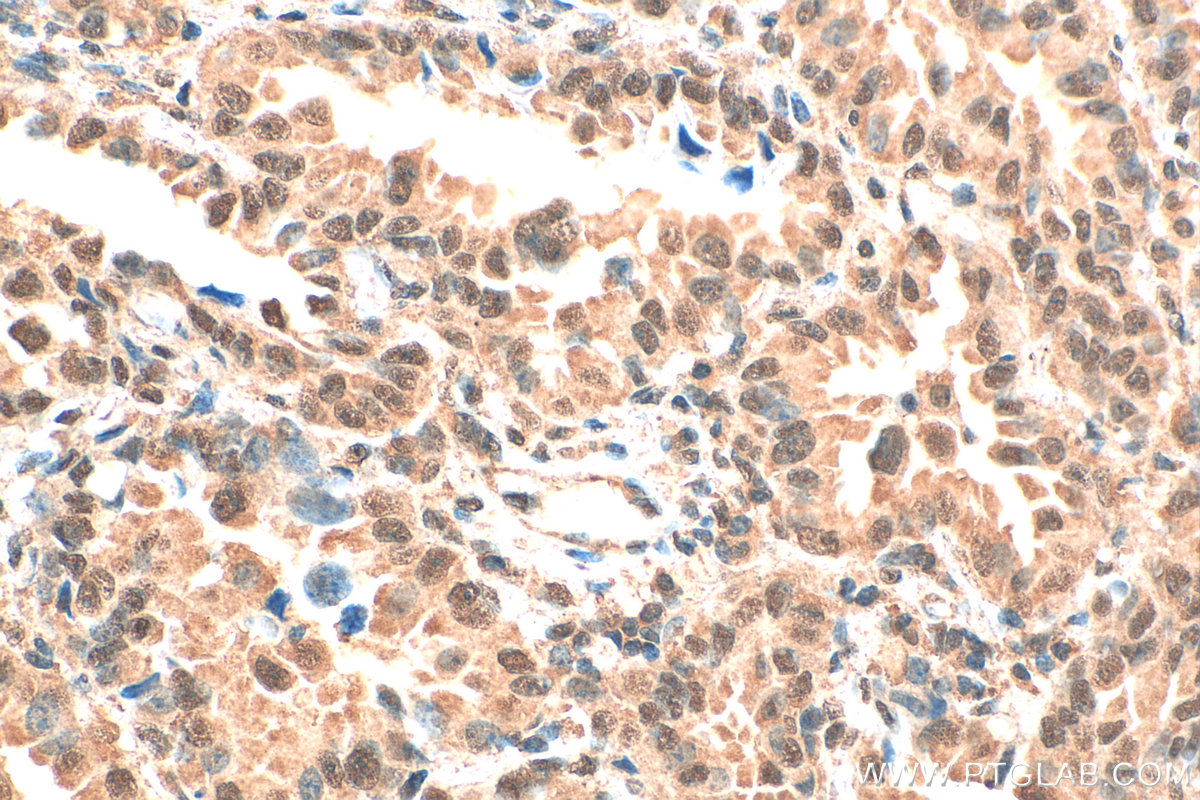 IHC staining of human lung cancer using 66730-1-Ig