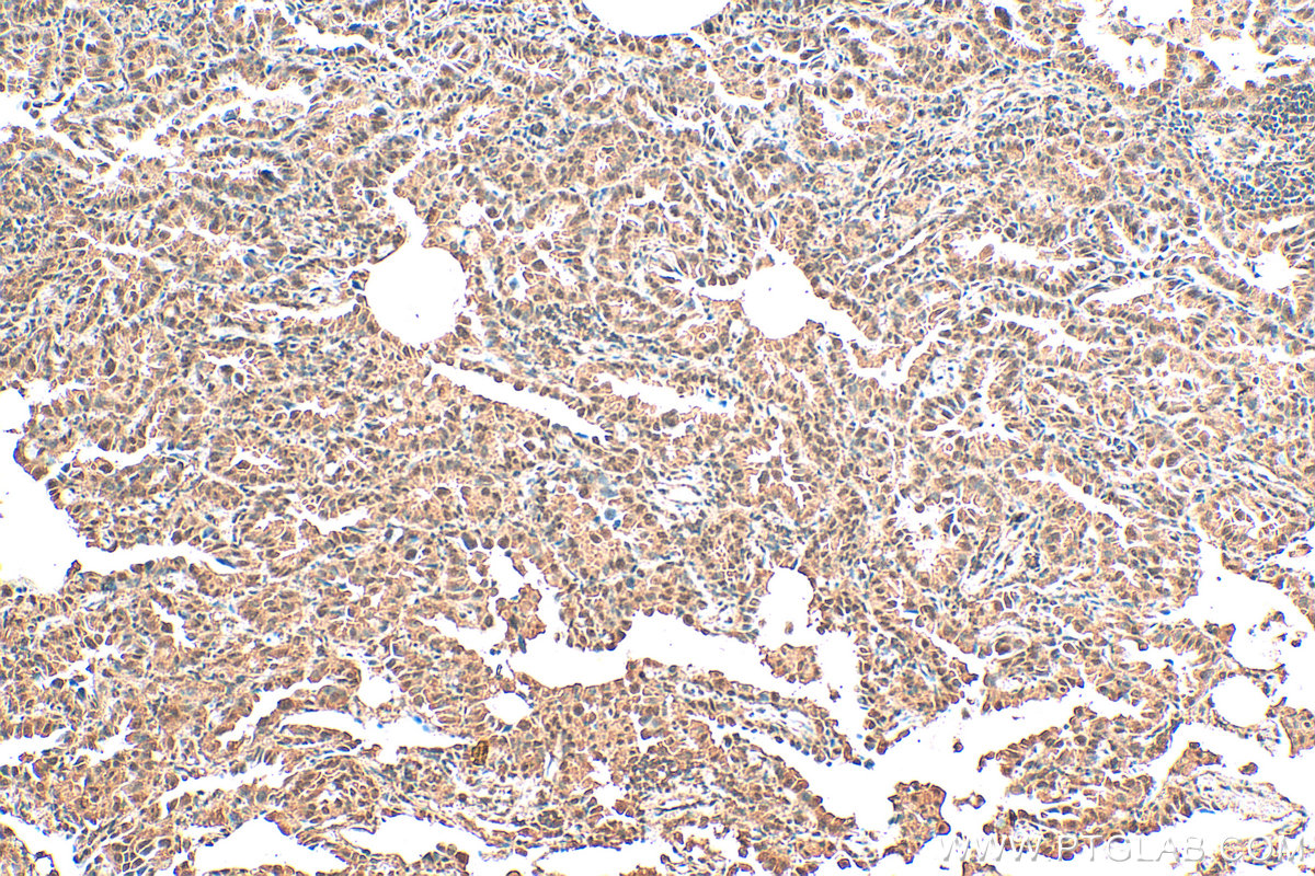 IHC staining of human lung cancer using 66730-1-Ig