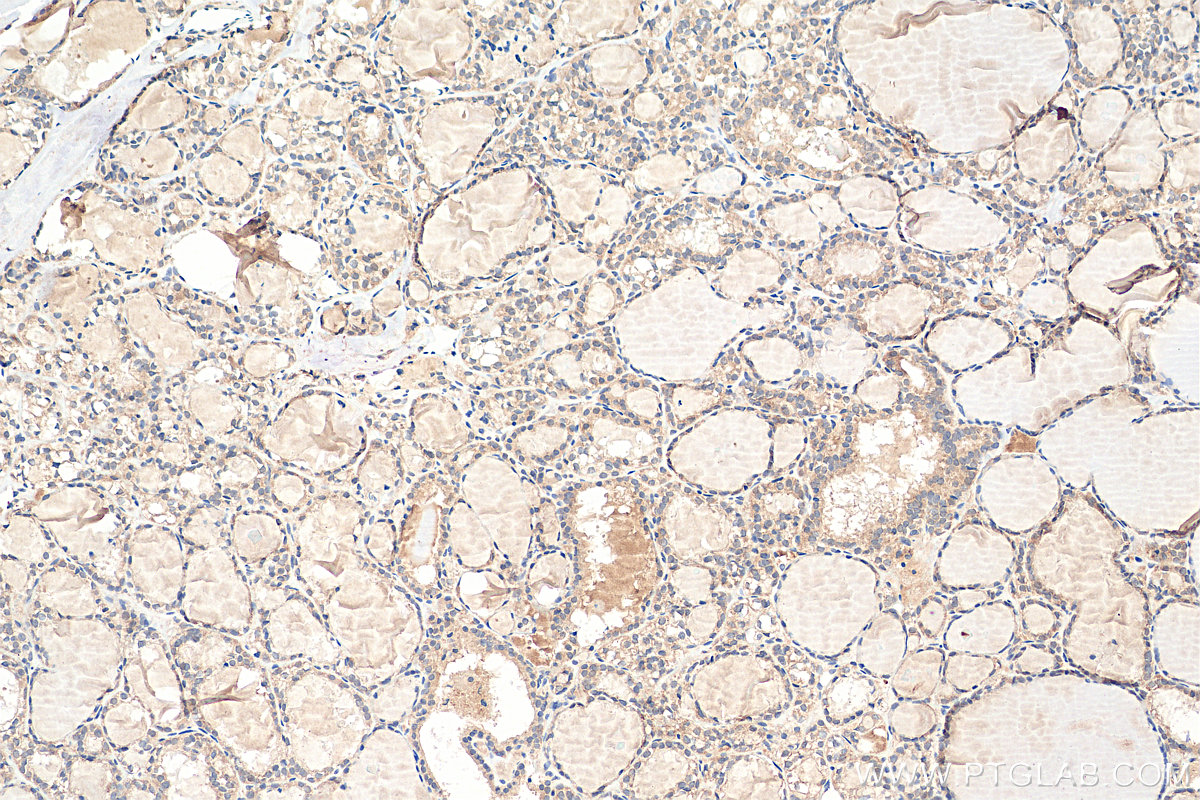 IHC staining of human thyroid cancer using 80933-1-RR (same clone as 80933-1-PBS)