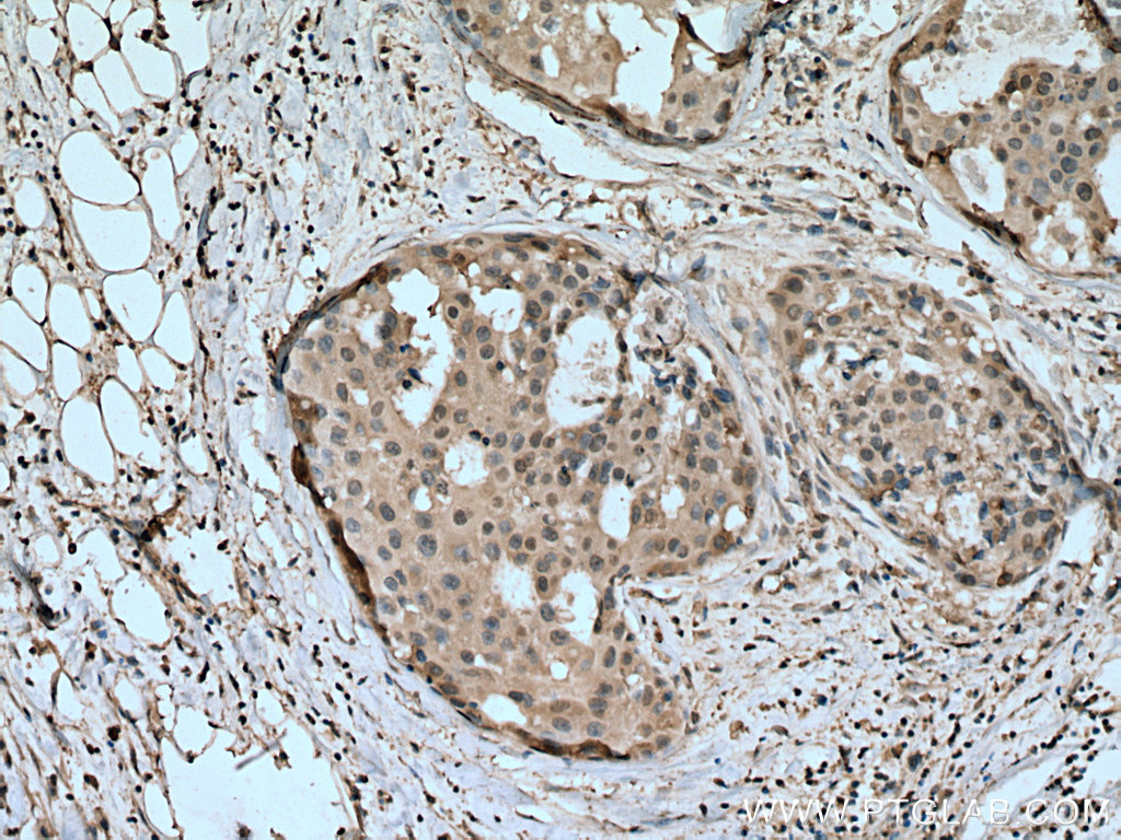 IHC staining of human breast cancer using 67583-1-Ig