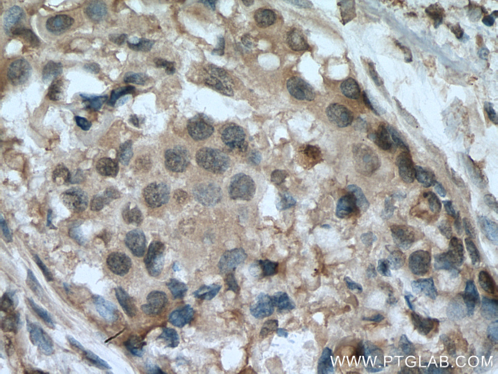 IHC staining of human breast cancer using 67583-1-Ig (same clone as 67583-1-PBS)