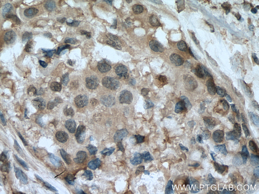 IHC staining of human breast cancer using 67583-1-Ig