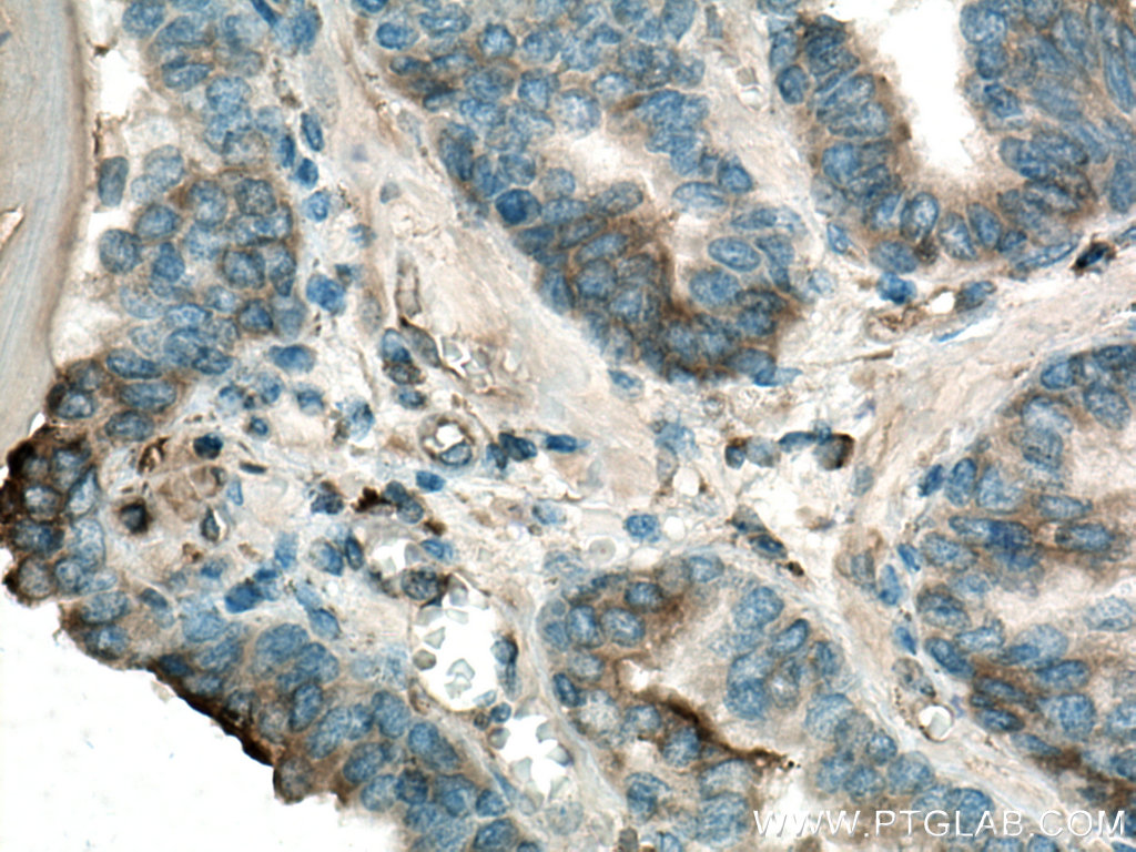 IHC staining of human prostate cancer using 22231-1-AP