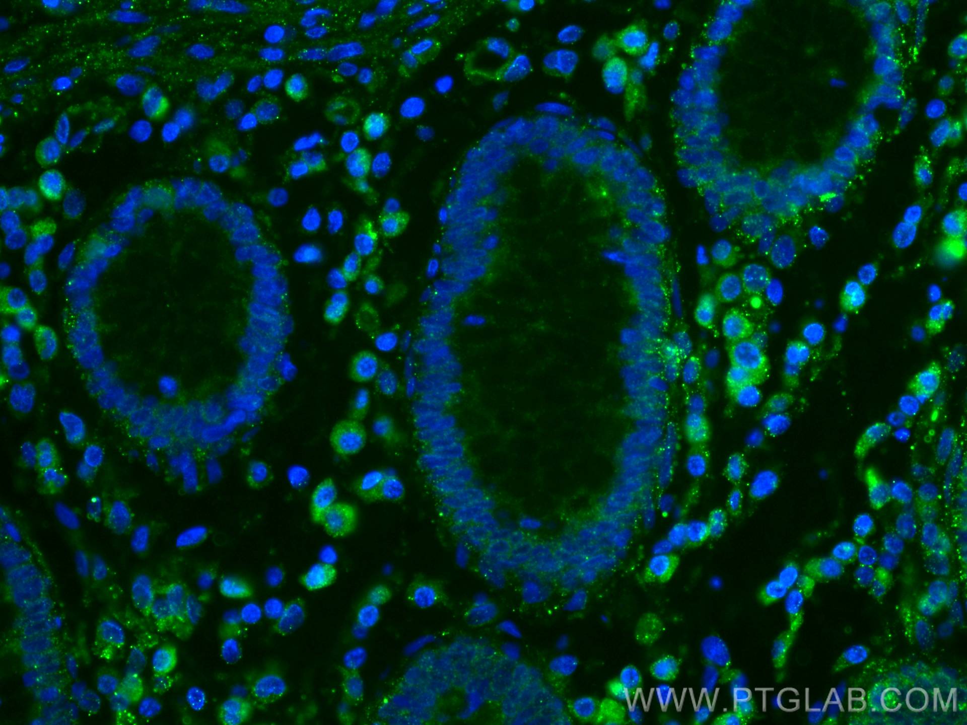 IF Staining of human colon cancer using 67163-1-Ig