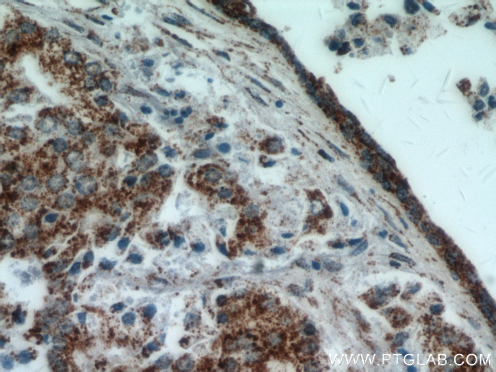 IHC staining of human prostate cancer using 19688-1-AP