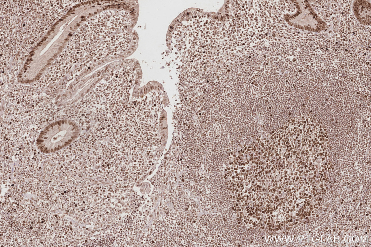 IHC staining of human appendicitis using 14992-1-AP IHC staining of human appendicitis using 14992-1-AP