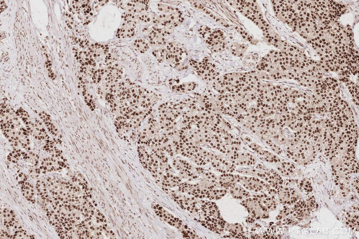 Immunohistochemical analysis of paraffin-embedded human stomach cancer tissue slide using 14992-1-AP (HIRIP3 antibody) at dilution of 1:1000 (under 10x lens). Heat mediated antigen retrieval with Tris-EDTA buffer (pH 9.0). IHC staining of human stomach cancer using 14992-1-AP