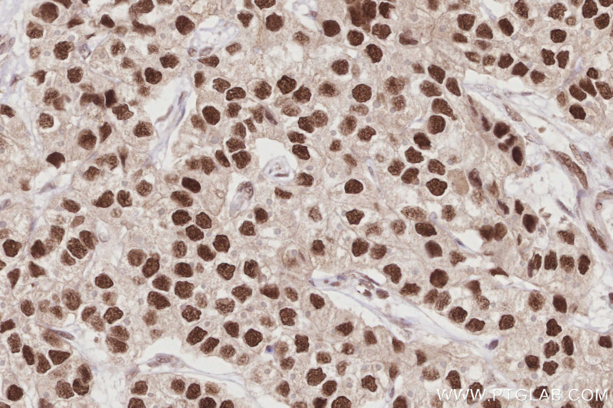 Immunohistochemical analysis of paraffin-embedded human stomach cancer tissue slide using 14992-1-AP (HIRIP3 antibody) at dilution of 1:1000 (under 40x lens). Heat mediated antigen retrieval with Tris-EDTA buffer (pH 9.0). IHC staining of human stomach cancer using 14992-1-AP