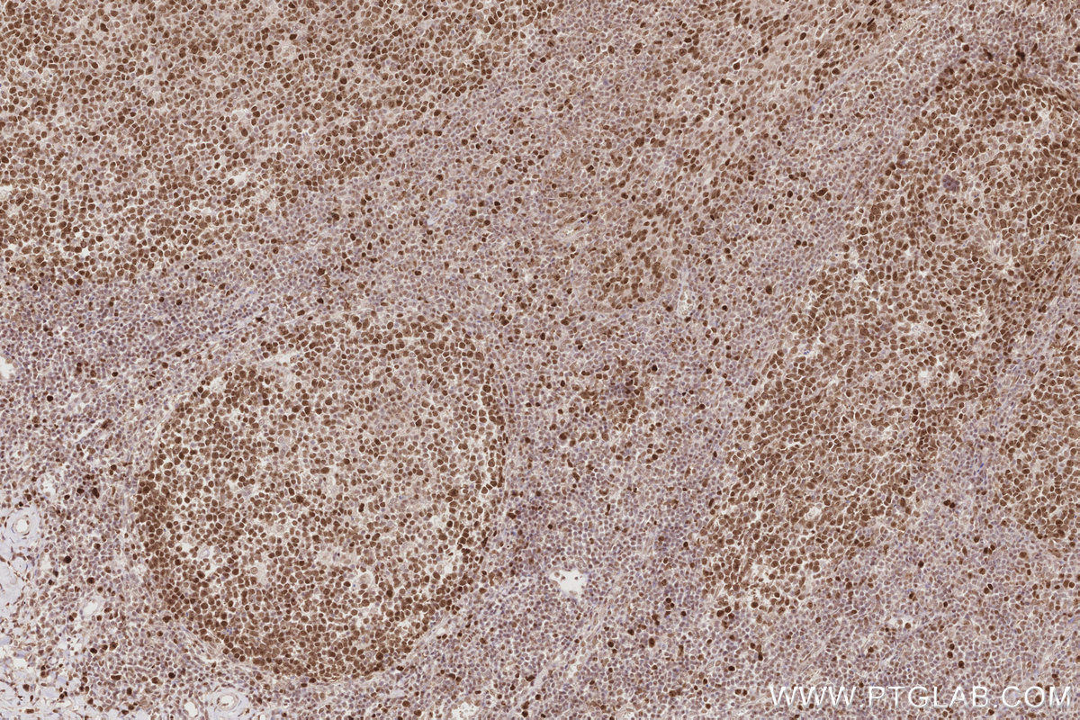 IHC staining of human tonsillitis using 14992-1-AP IHC staining of human tonsillitis using 14992-1-AP
