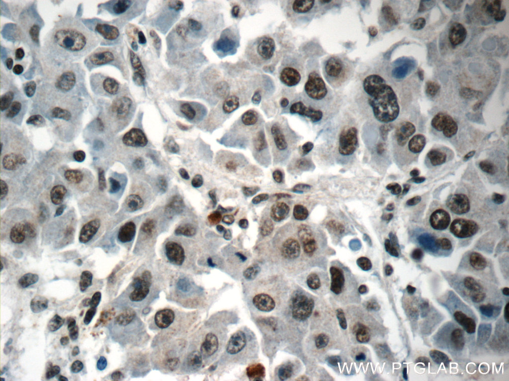 IHC staining of human liver cancer using 15302-1-AP