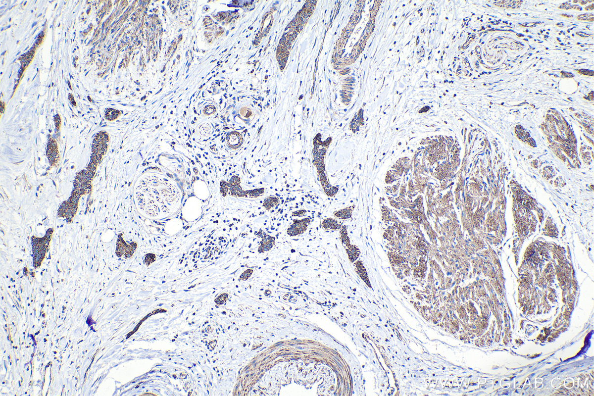 IHC staining of human urothelial carcinoma using 22029-1-AP