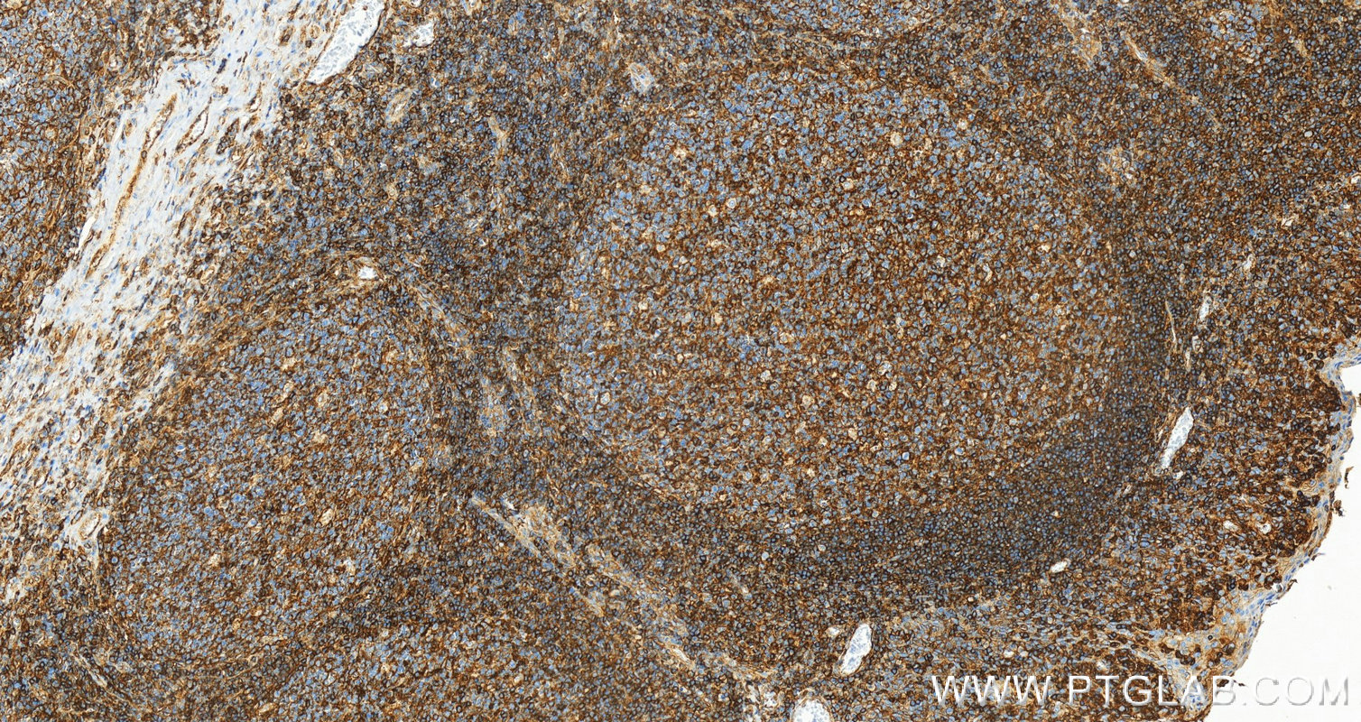 IHC staining of human tonsillitis using 15240-1-AP