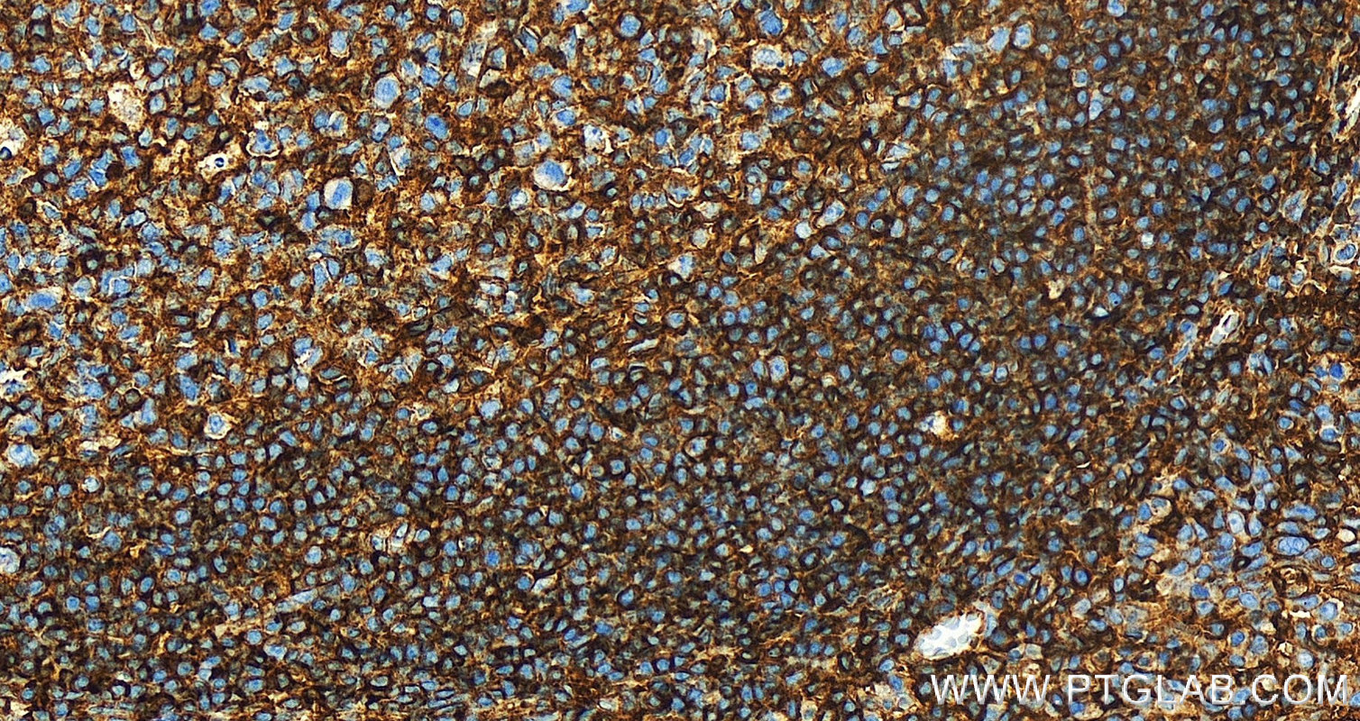 IHC staining of human tonsillitis using 15240-1-AP