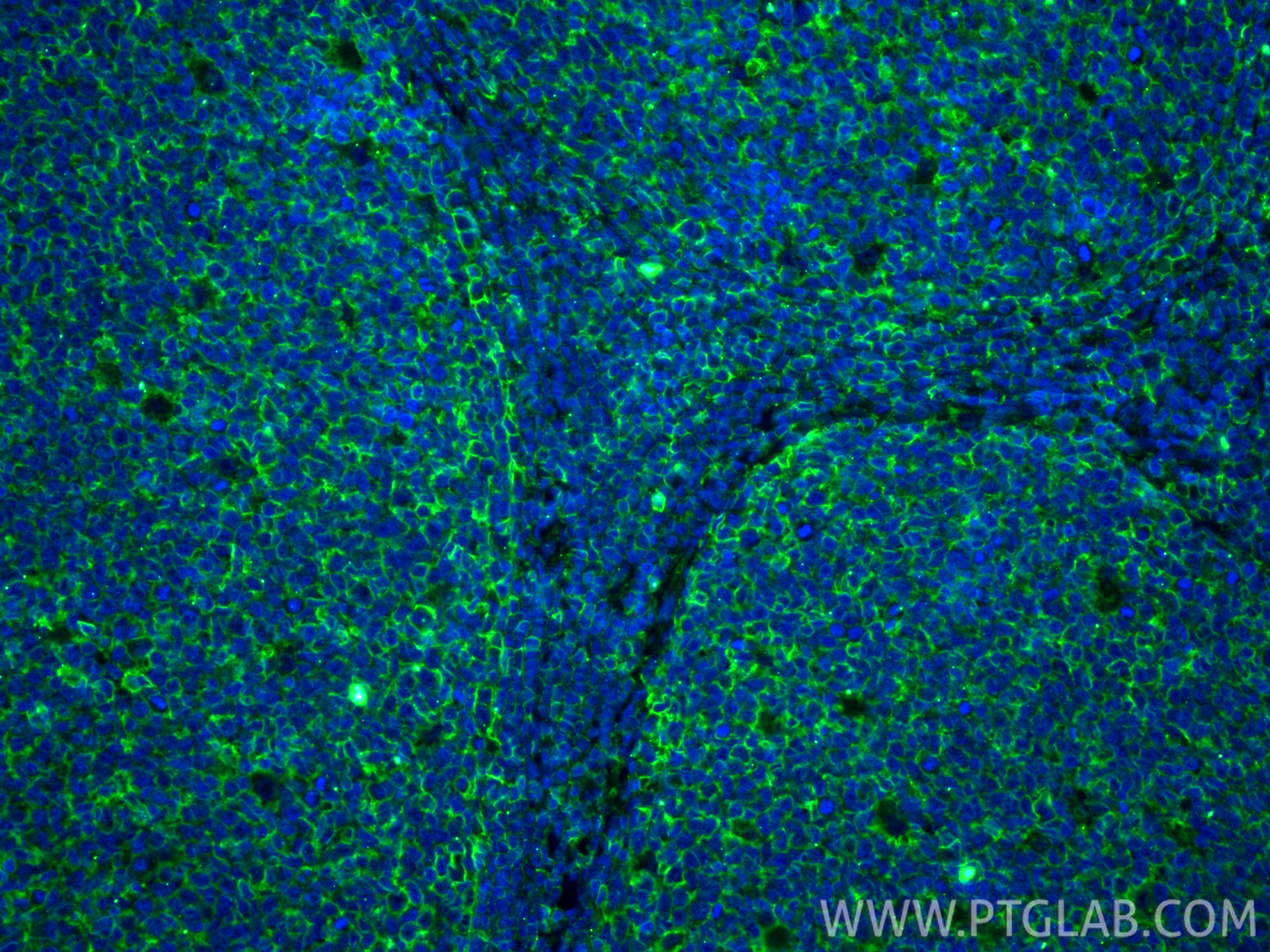 IF Staining of human tonsillitis using 66013-1-Ig IF Staining of human tonsillitis using 66013-1-Ig