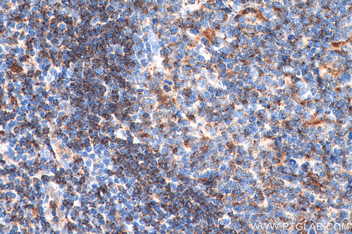 IHC staining of human tonsillitis using 11838-1-AP (same clone as 11838-1-PBS)