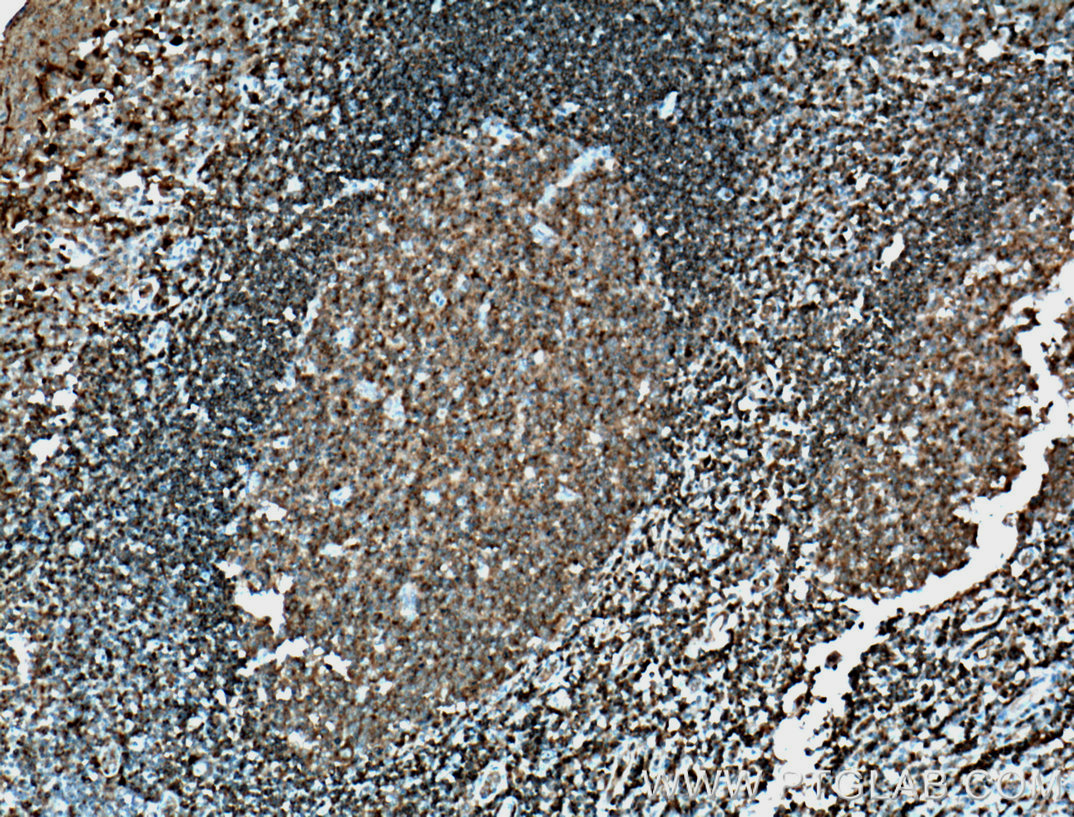 IHC staining of human tonsillitis using 21704-1-AP