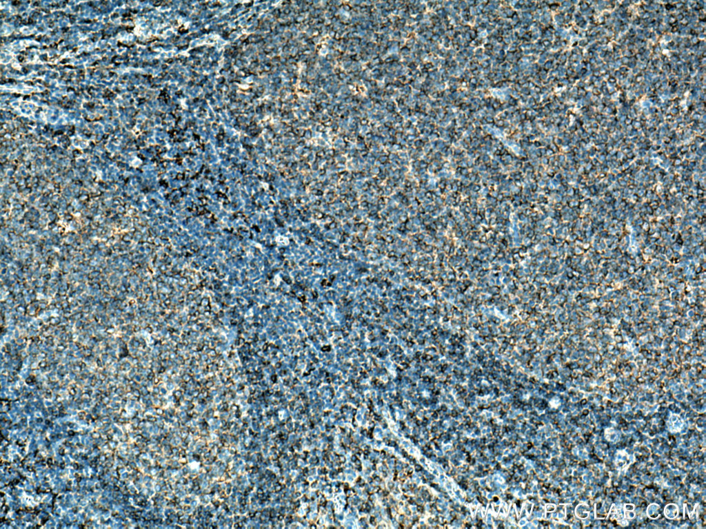 IHC staining of human tonsillitis using 16109-1-AP