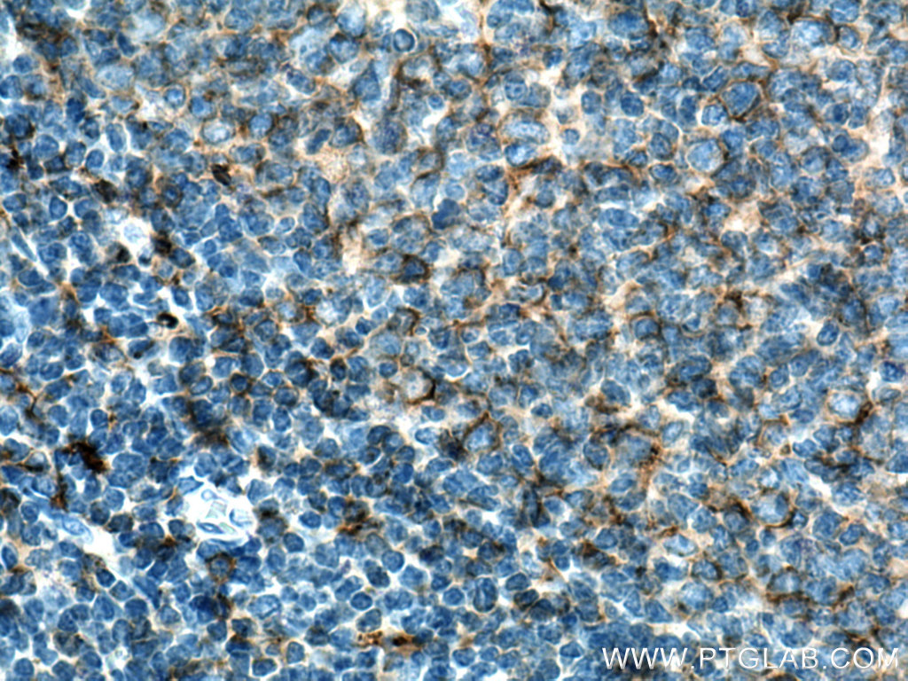 IHC staining of human tonsillitis using 16109-1-AP