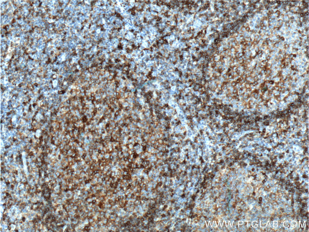 IHC staining of human tonsillitis using 16918-1-AP