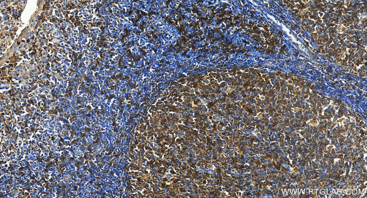 IHC staining of human tonsillitis using 16918-1-AP