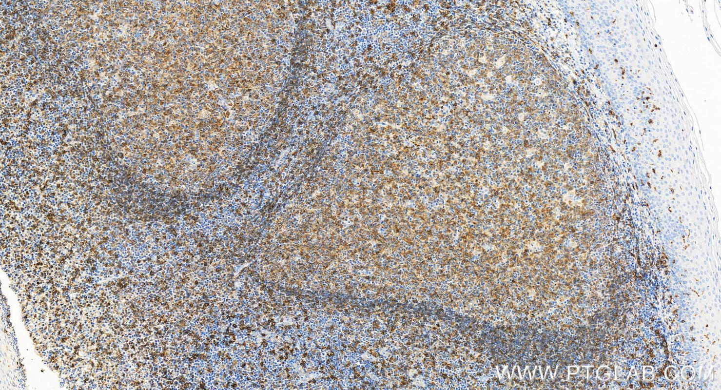 IHC staining of human tonsillitis using 32281-1-AP