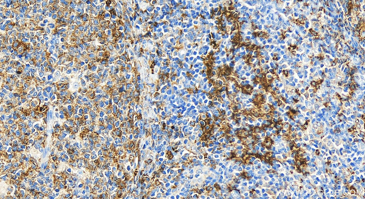 IHC staining of human tonsillitis using 32281-1-AP