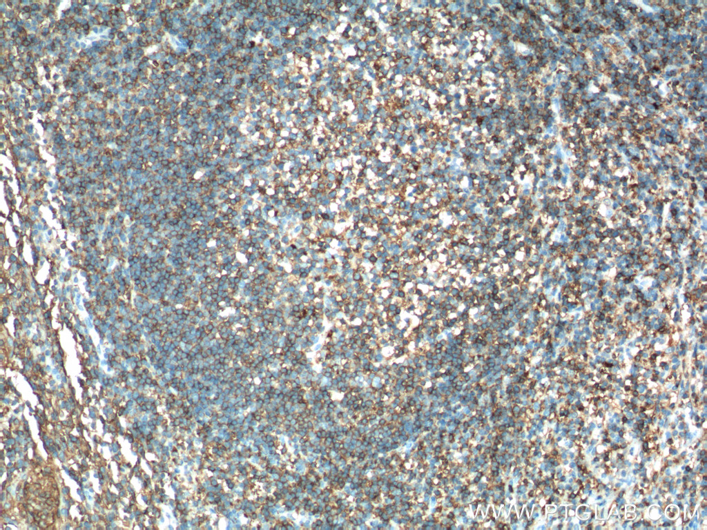 IHC staining of human tonsillitis using 17221-1-AP