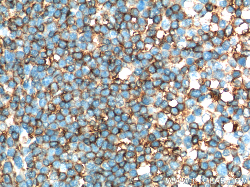 IHC staining of human tonsillitis using 17221-1-AP