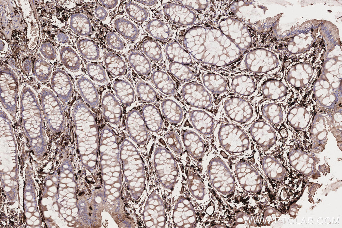 IHC staining of human rectal cancer using 68543-1-Ig IHC staining of human rectal cancer using 68543-1-Ig