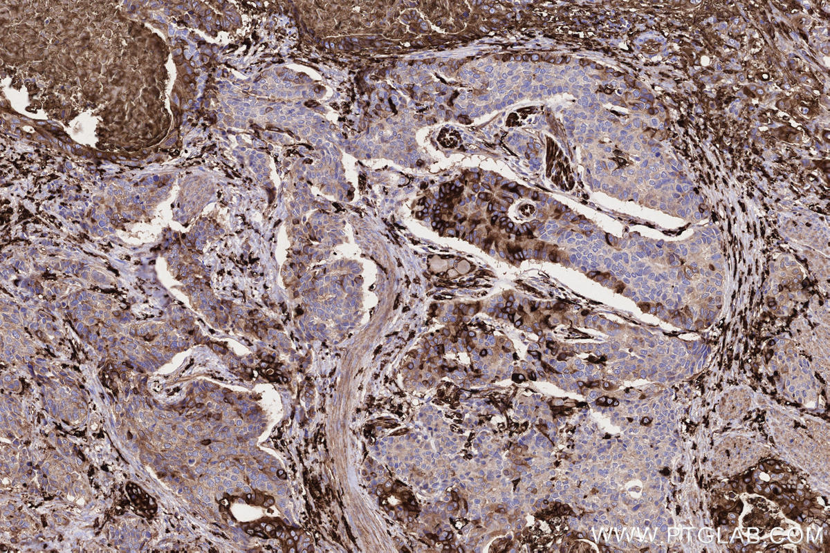 IHC staining of human stomach cancer using 68543-1-Ig IHC staining of human stomach cancer using 68543-1-Ig