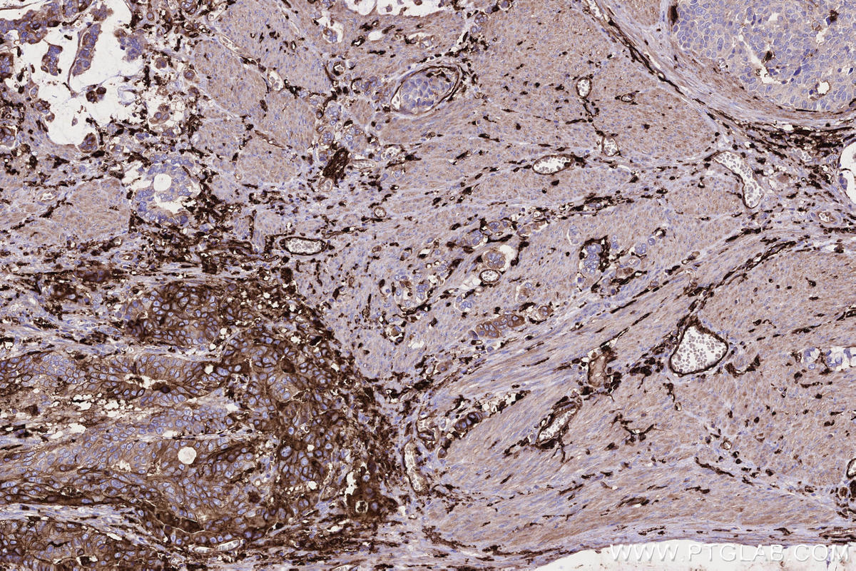 IHC staining of human stomach cancer using 68543-1-Ig IHC staining of human stomach cancer using 68543-1-Ig