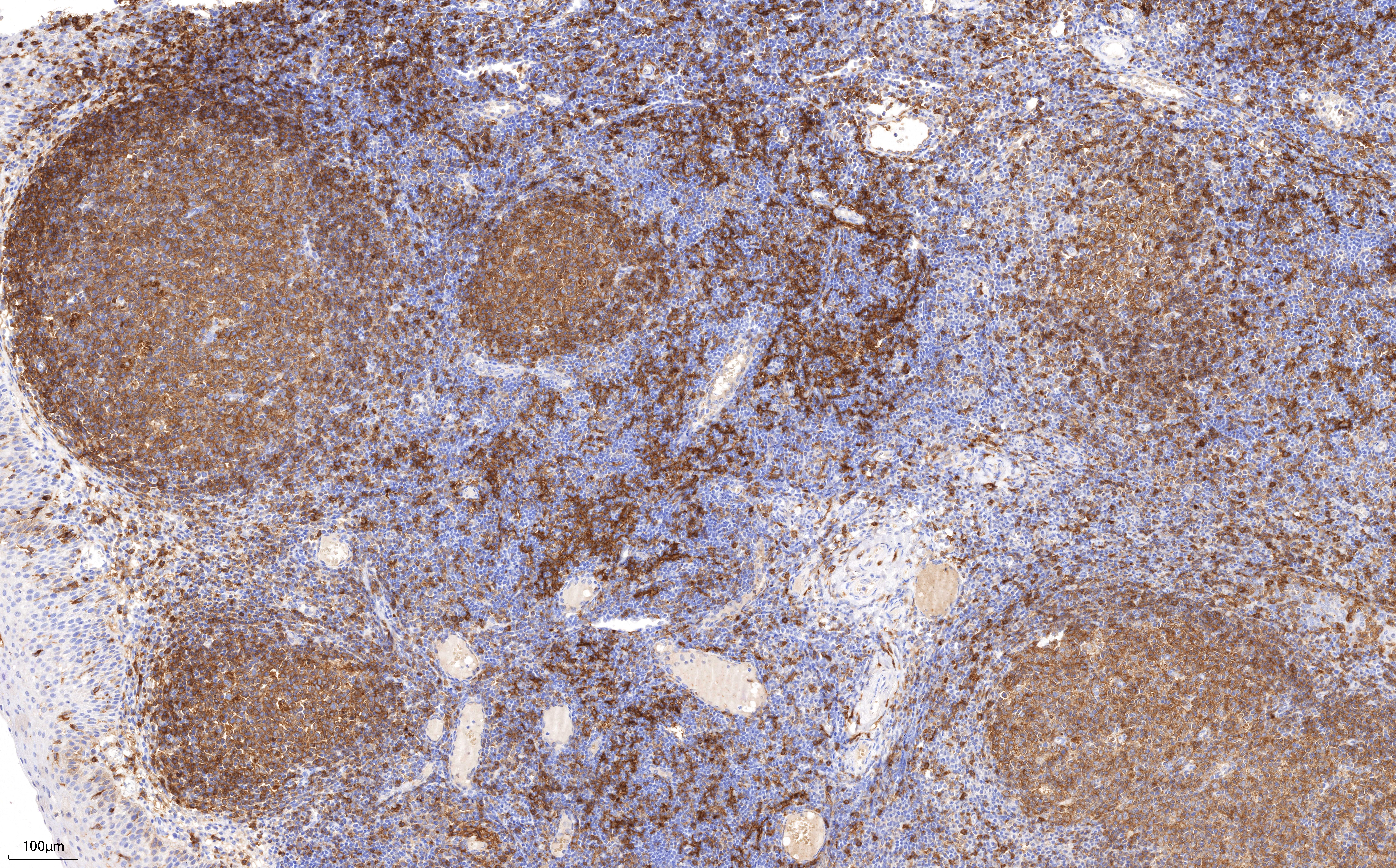 IHC staining of human tonsillitis using 68543-1-Ig