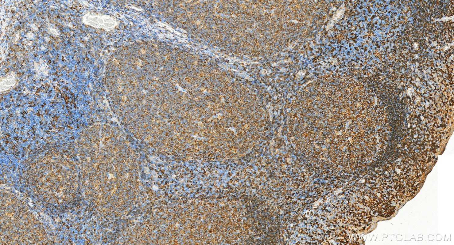 IHC staining of human tonsillitis using 15733-1-AP