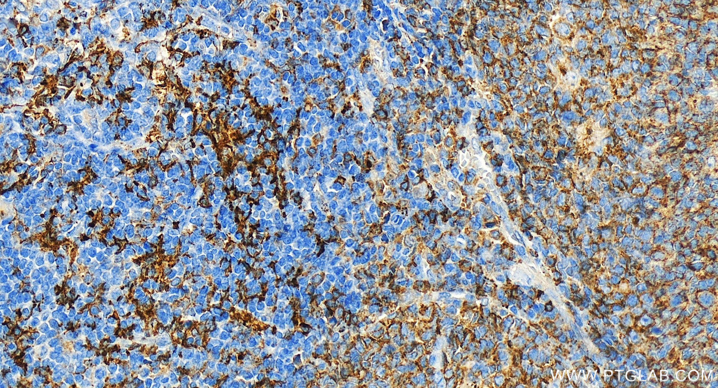 IHC staining of human tonsillitis using 15733-1-AP