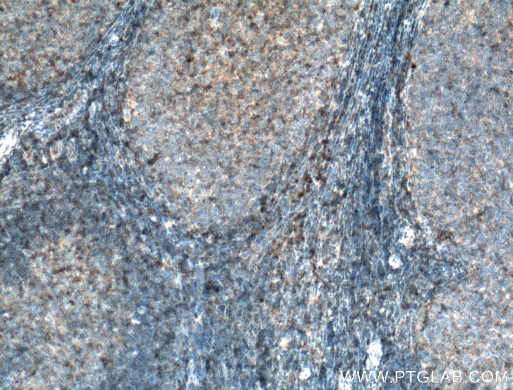 IHC staining of human tonsillitis using 27411-1-AP